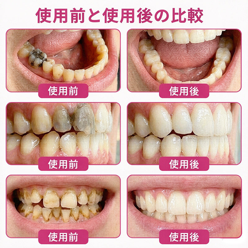 CleraNaure® DenPerm 虫歯修復 天然エナメル質充填ジェル🛡️