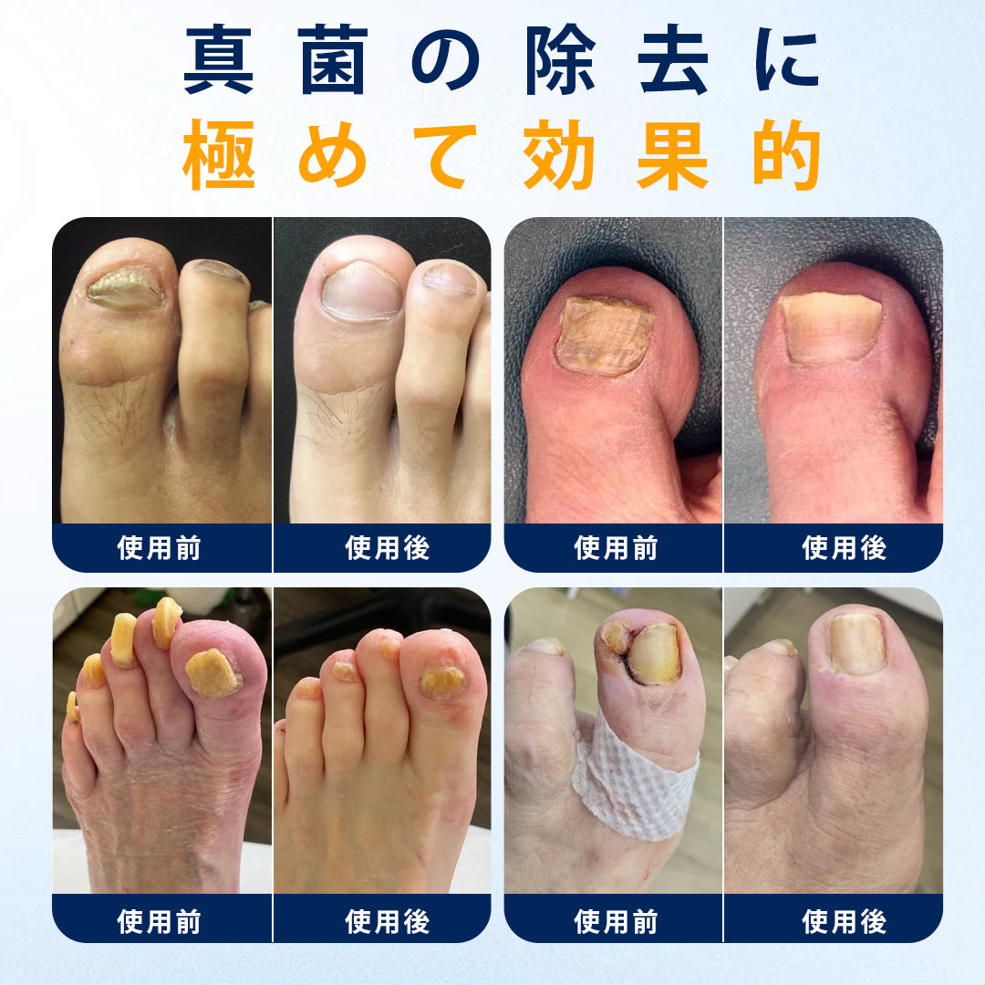 CleraNaure® 爪水虫緩和スプレー