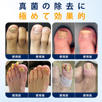 CleraNaure® 爪水虫緩和スプレー