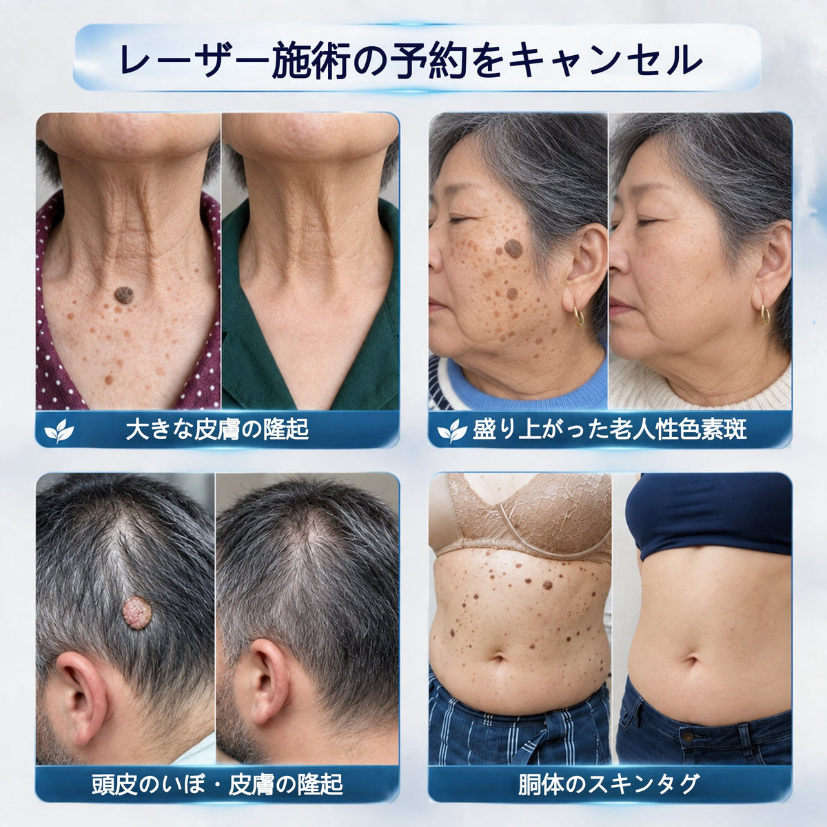 CleraNaure® 7日間スキンタグ＆スポット消去クリーム（痛みゼロ・傷跡ゼロ処方）