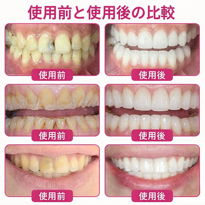 CleraNaure® DenPerm 虫歯修復 天然エナメル質充填ジェル🛡️