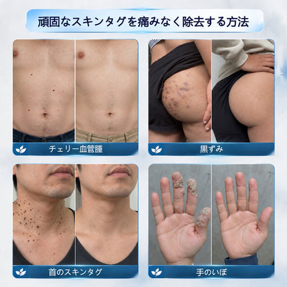 CleraNaure® 7日間スキンタグ＆スポット消去クリーム（痛みゼロ・傷跡ゼロ処方）
