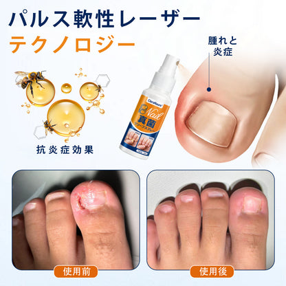 CleraNaure® 爪水虫緩和スプレー
