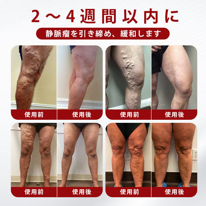 CleraNaure® 静脈瘤クリーム✨
