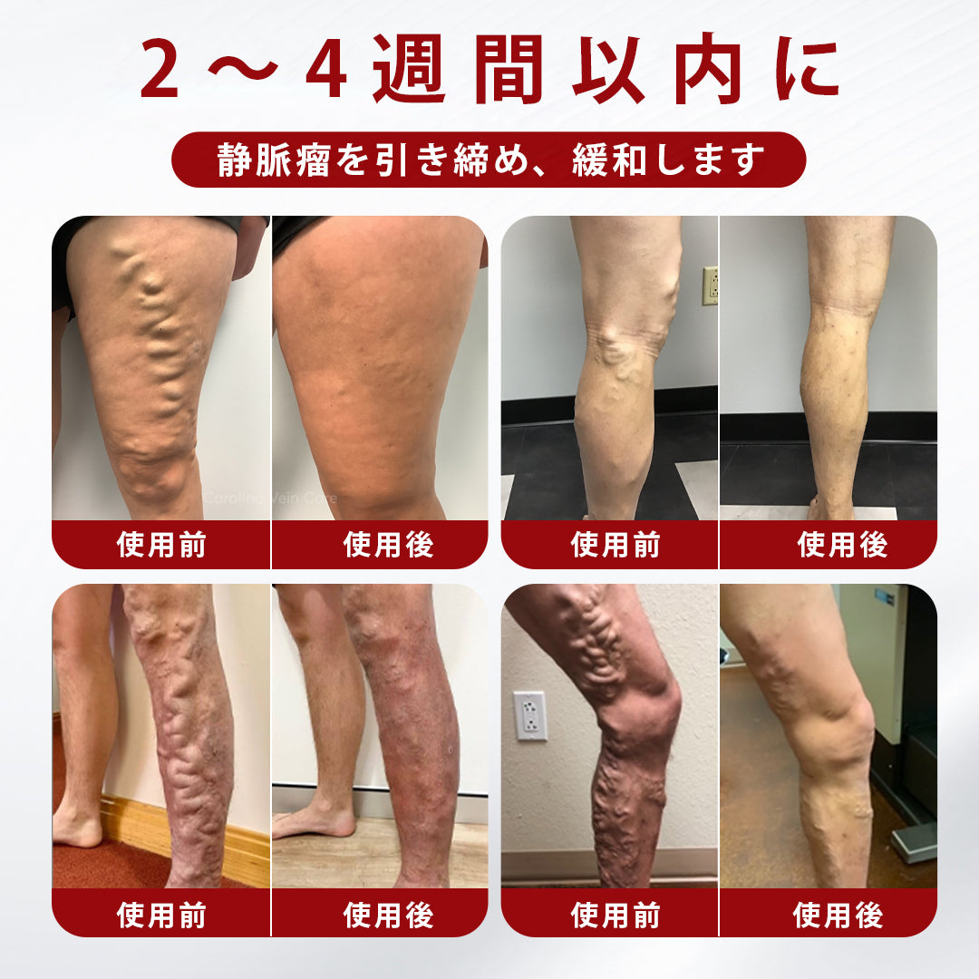 CleraNaure® 静脈瘤クリーム✨