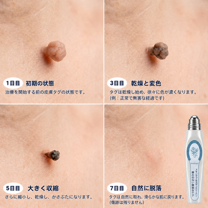 薬剤師もおすすめ💛 𝑯𝗲𝙖𝐥𝒓𝗶𝙯𝗲® 7日間 タグ＆スポットイレーサー🪄 （痛みゼロ・傷あとゼロを目指すローラーボールタイプ）👩‍⚕️